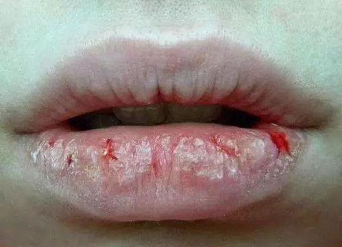 吃白色瓜嘴唇疼